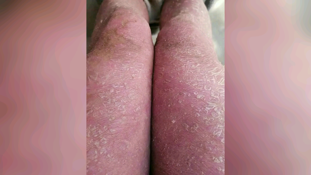 红皮型银屑病是什么? - 知乎