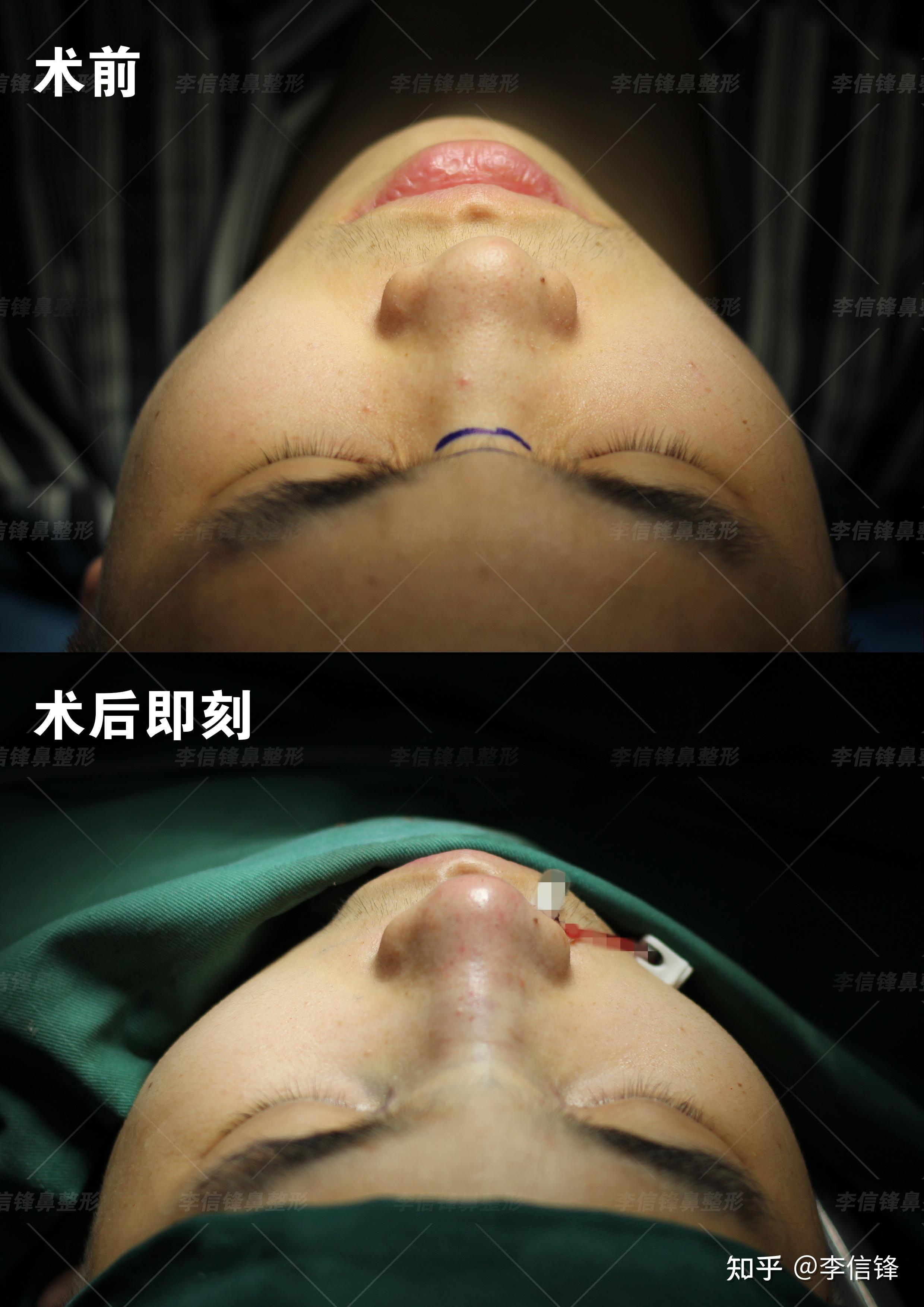 初鼻-男生隆鼻案例,面中部凹陷、嘴凸改善,术后即刻~深圳李信锋隆鼻综合整形案例分享 - 知乎