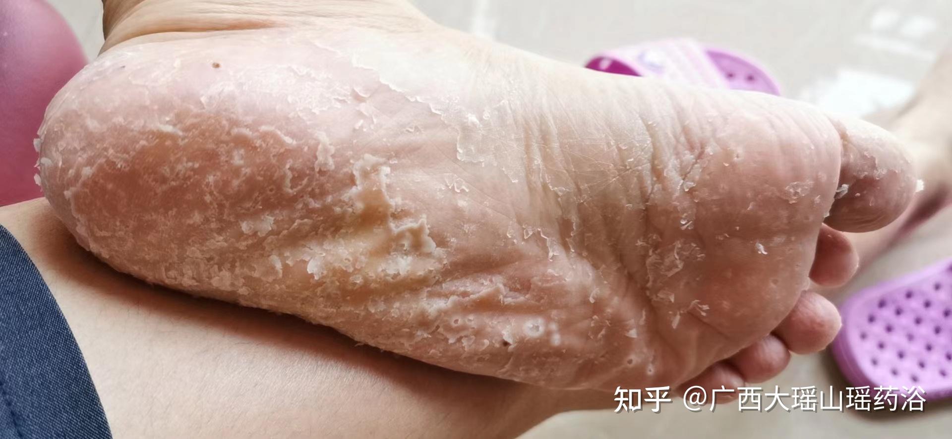 你们的水泡型脚气是怎么治好的?求分享经验?