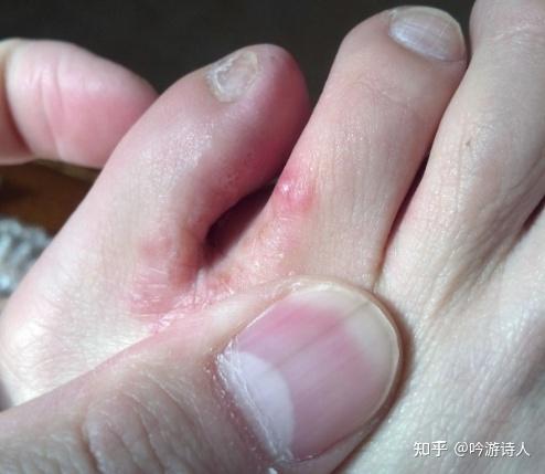 谁知道治水泡脚气的方法,求解? - 知乎