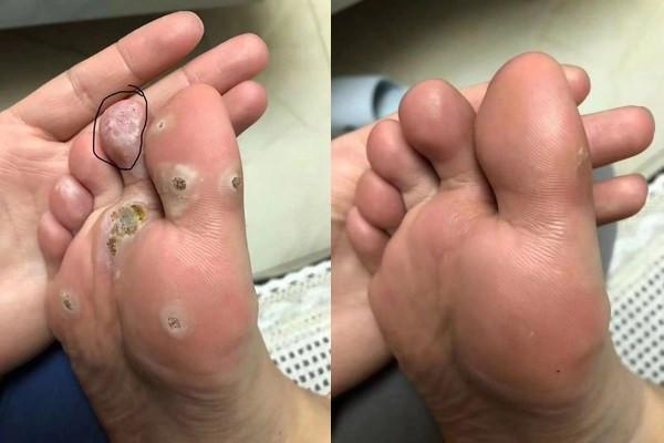瑶张记跖疣里面的黑刺能拔吗跖疣上的黑点是什么
