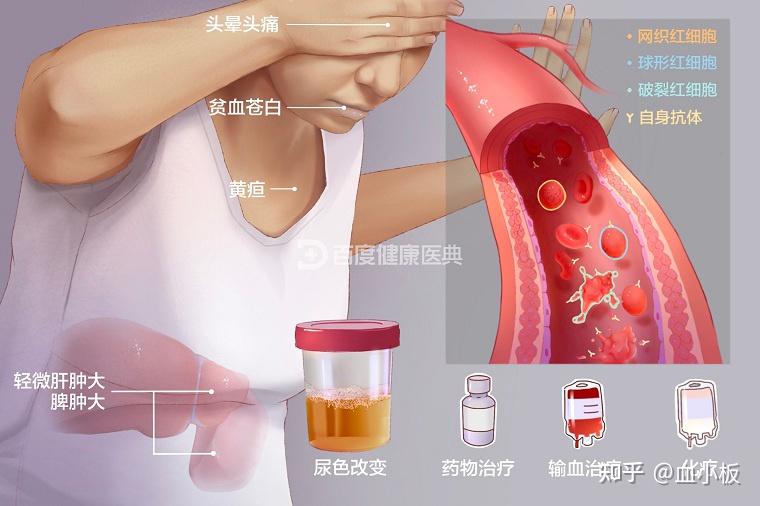 溶血性贫血到底是什么？ - 知乎