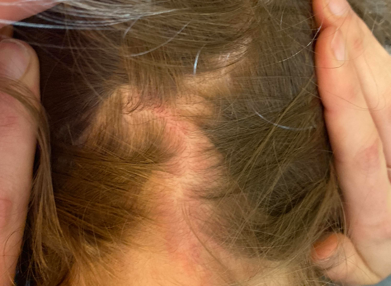 请教系统性红斑狼疮脱发的原因是什么?能否恢复?怎么算脱发?