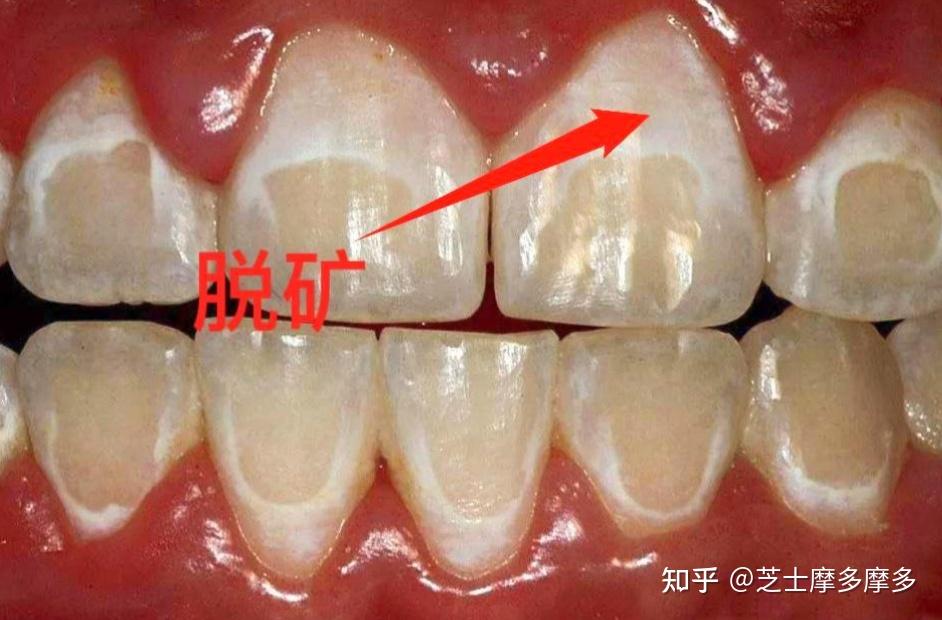 正畸后牙齿脱矿怎么办?还有救吗? - 知乎