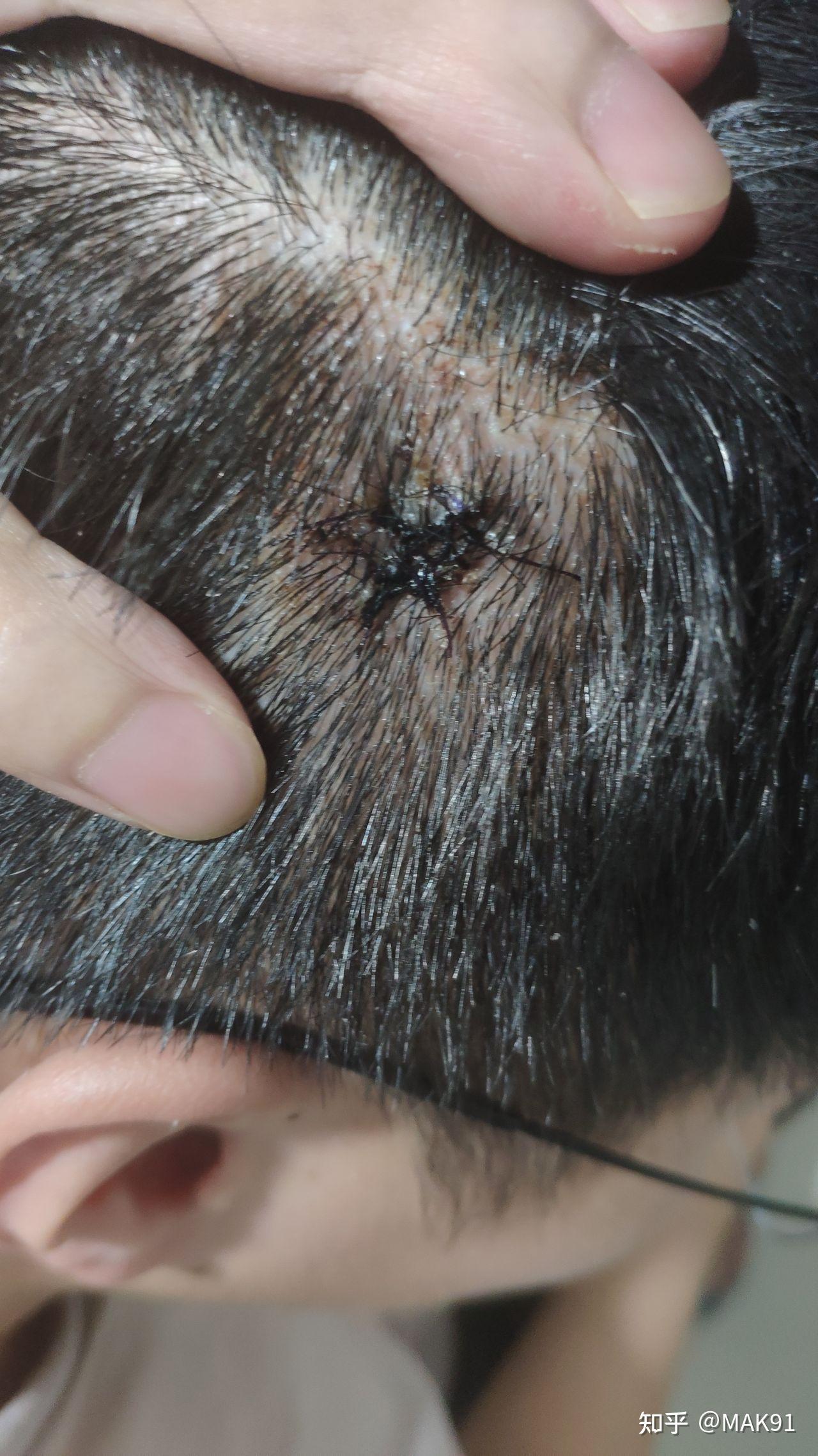 头皮上长了一个红色的小肉球不疼不痒的问一下是啥? - 知乎