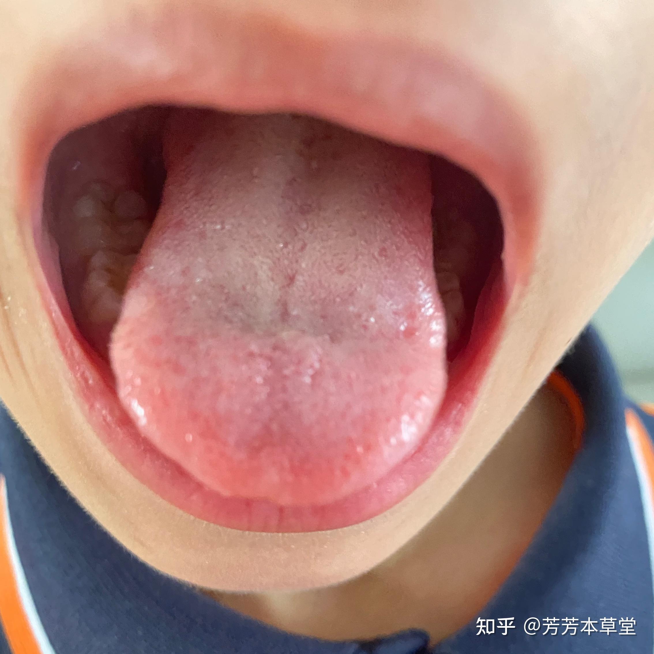 宝宝扁桃体发炎总发烧家长该怎么预防