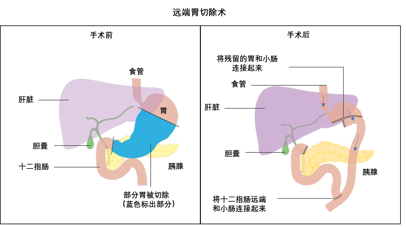 胃癌,如果把胃全部切除,能活多久?