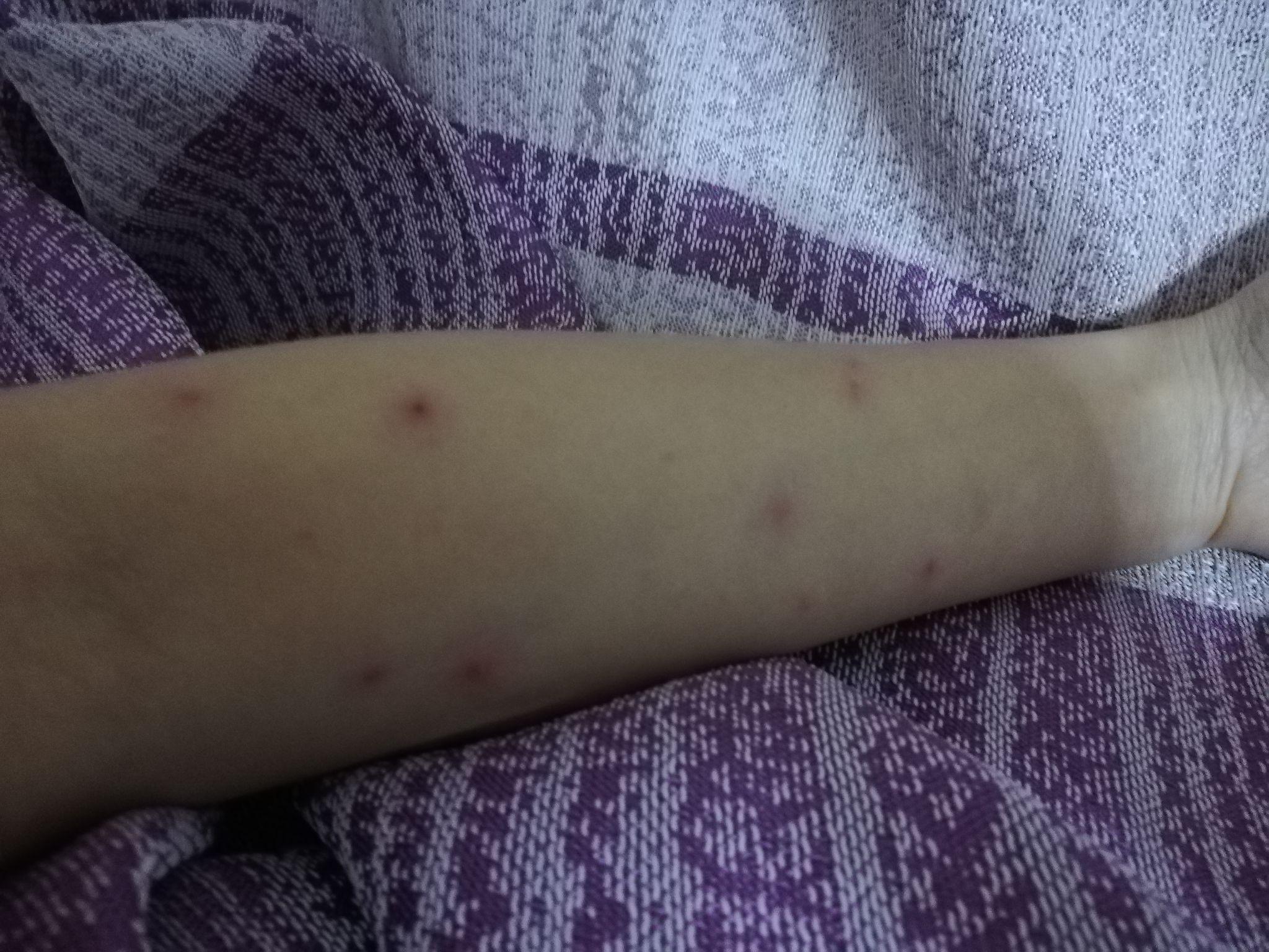 成人长水痘是什么样的经历