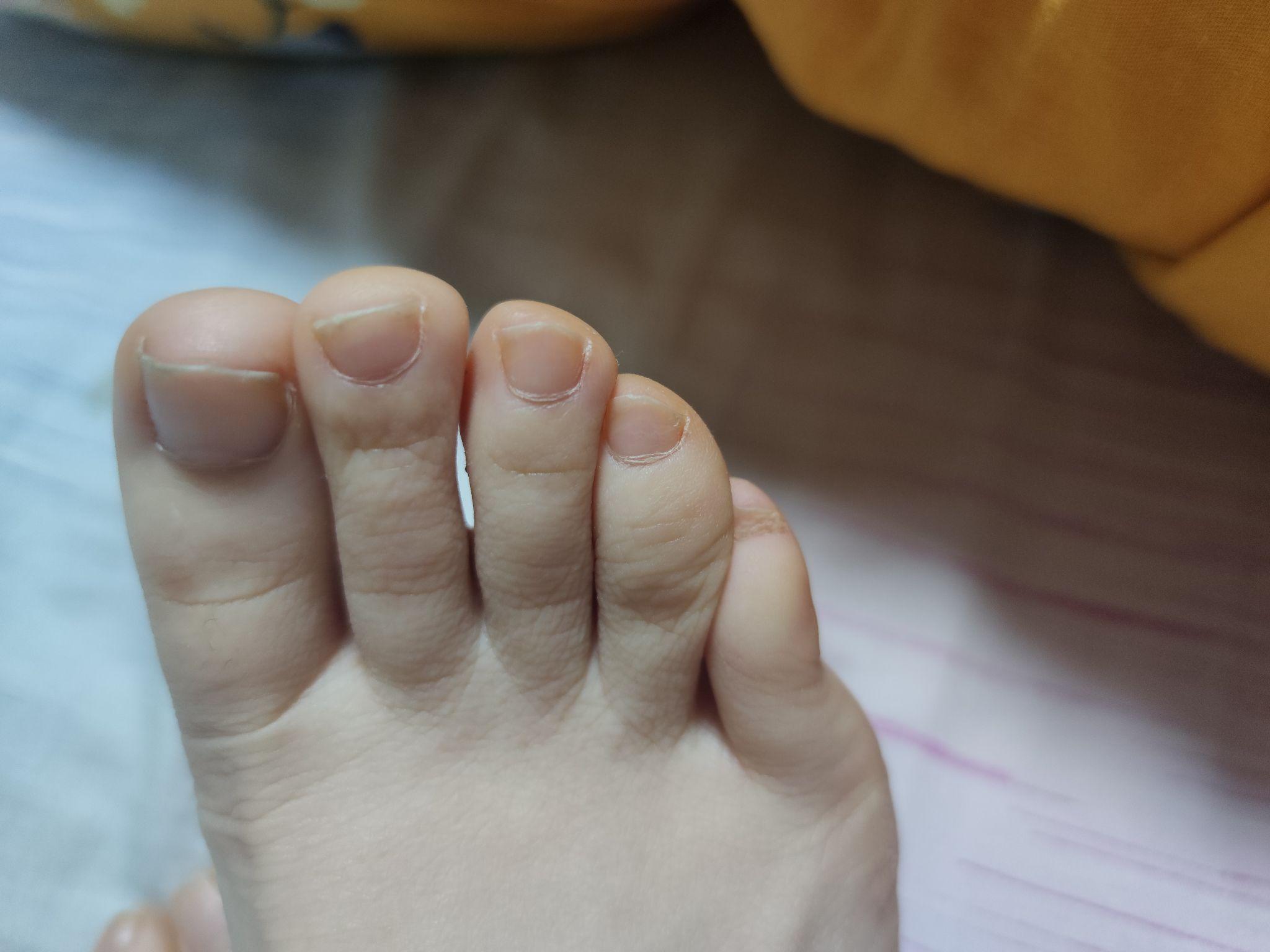 这属于小拇指内翻吗? - 知乎