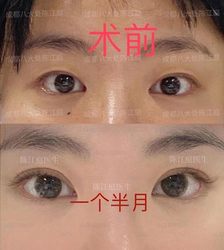 成都双眼皮:双眼皮术后护理方法有哪些? - 知乎