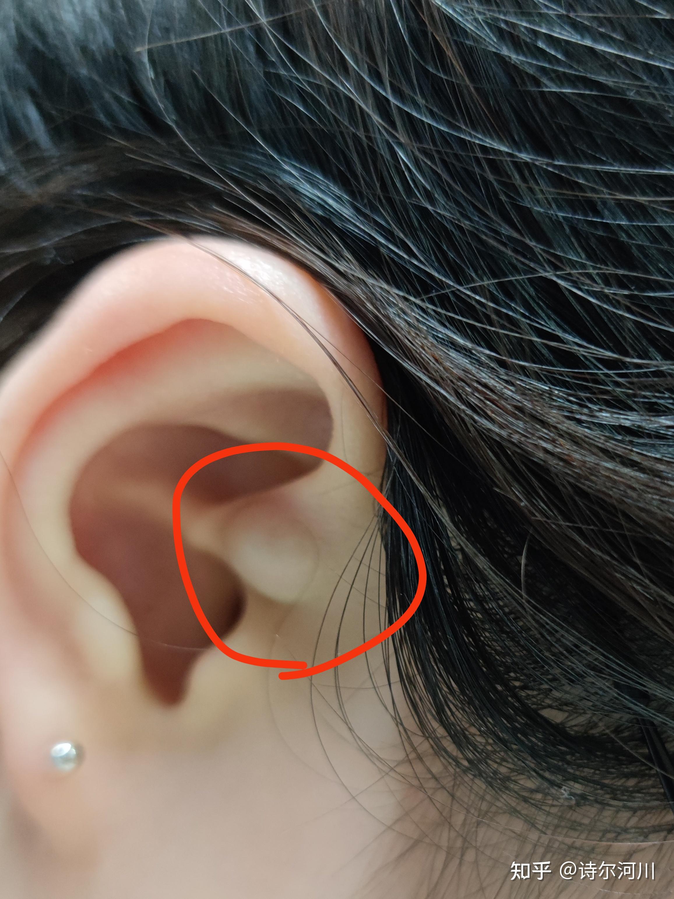 皮脂腺囊肿初期长啥样? - 知乎