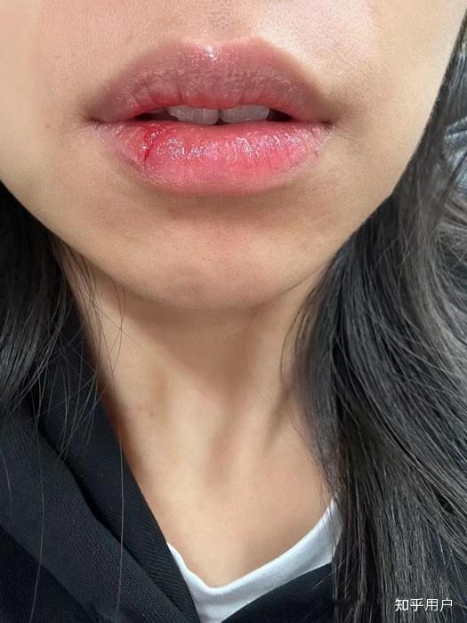 嘴唇干燥起皮应该如何护理