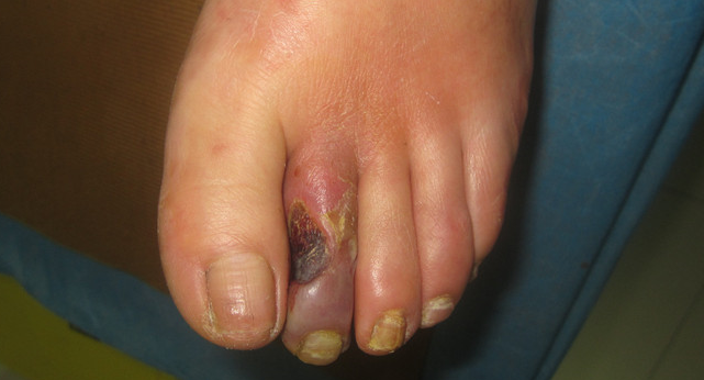 糖尿病足湿性坏疽的症状表现是什么