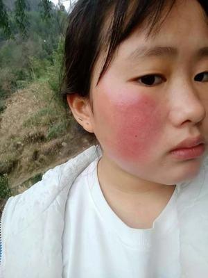 大红脸蛋上的红血丝怎样去除呢