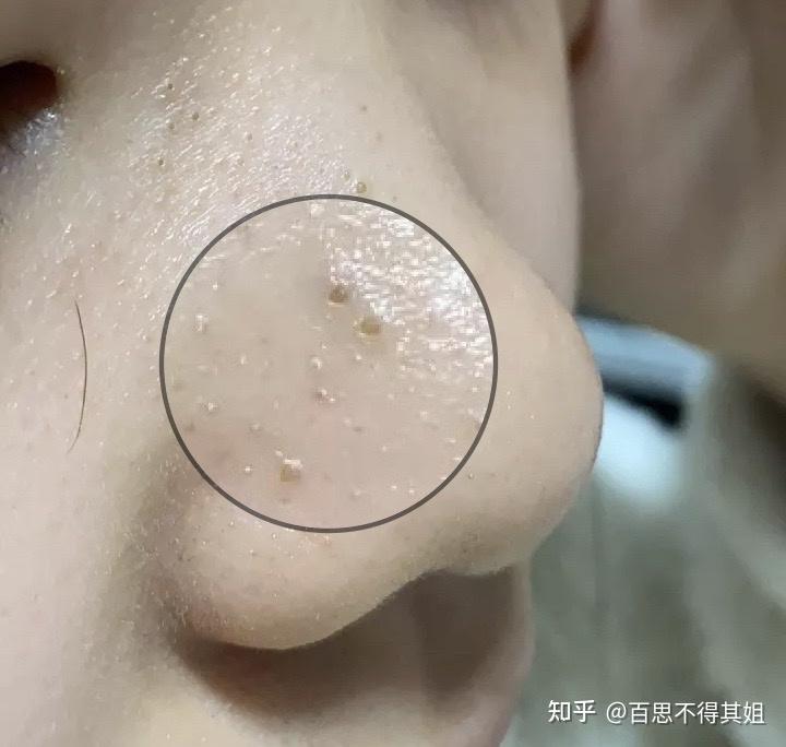 请问有什么适合学生党缓解黑头的办法 ? - 知乎