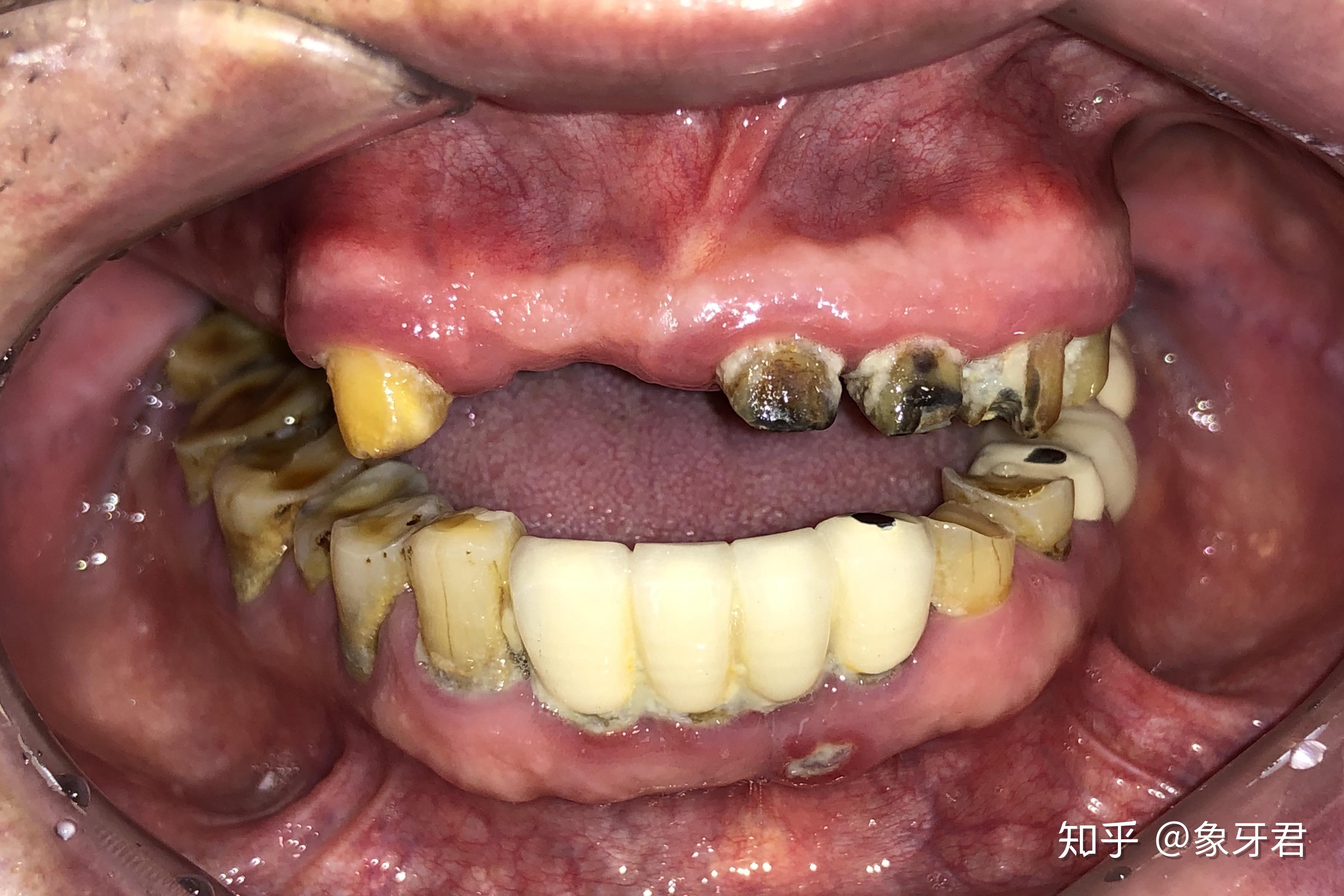 蛀牙不补可以吗? - 知乎