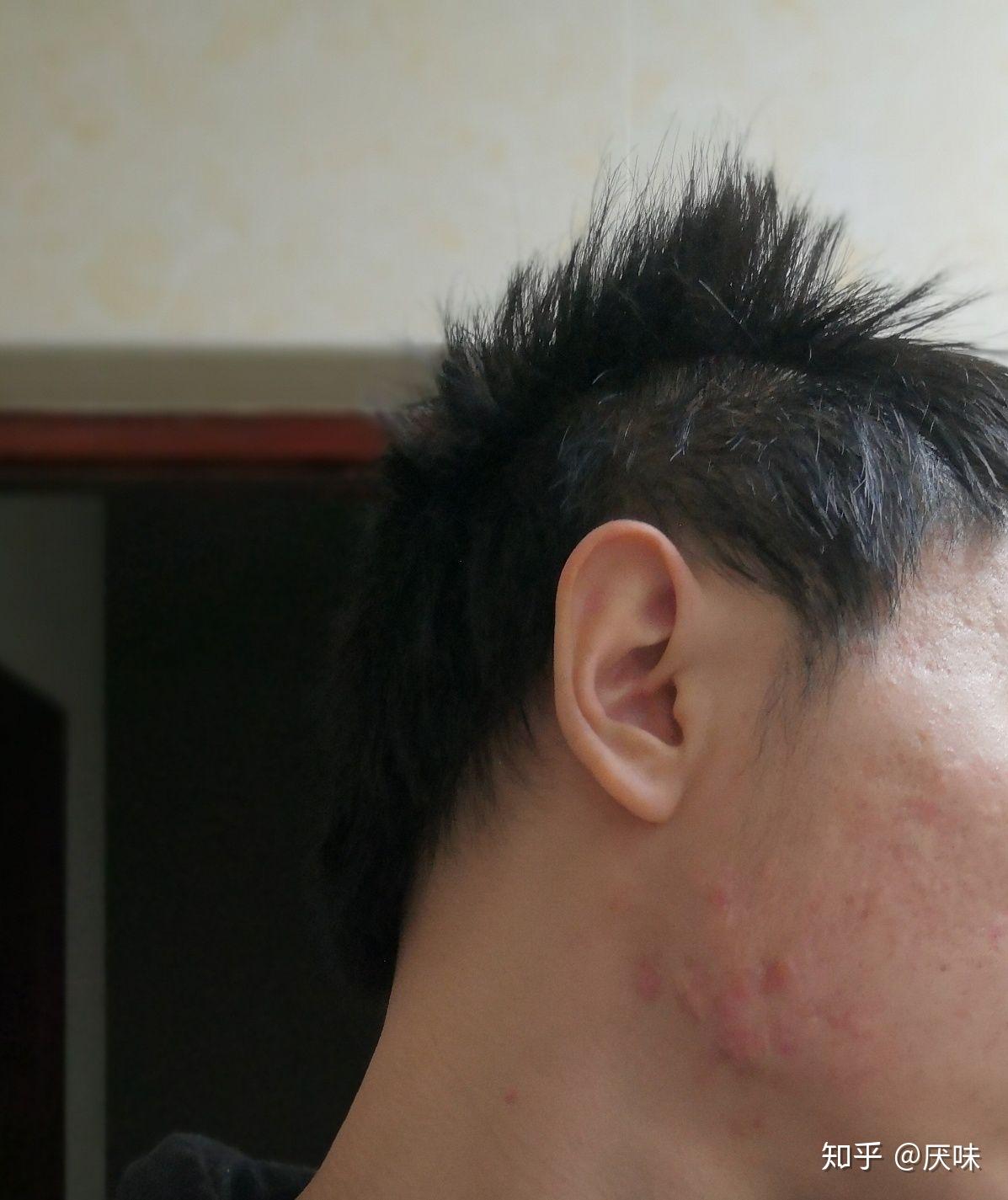 满脸痘坑的人都活得怎么样