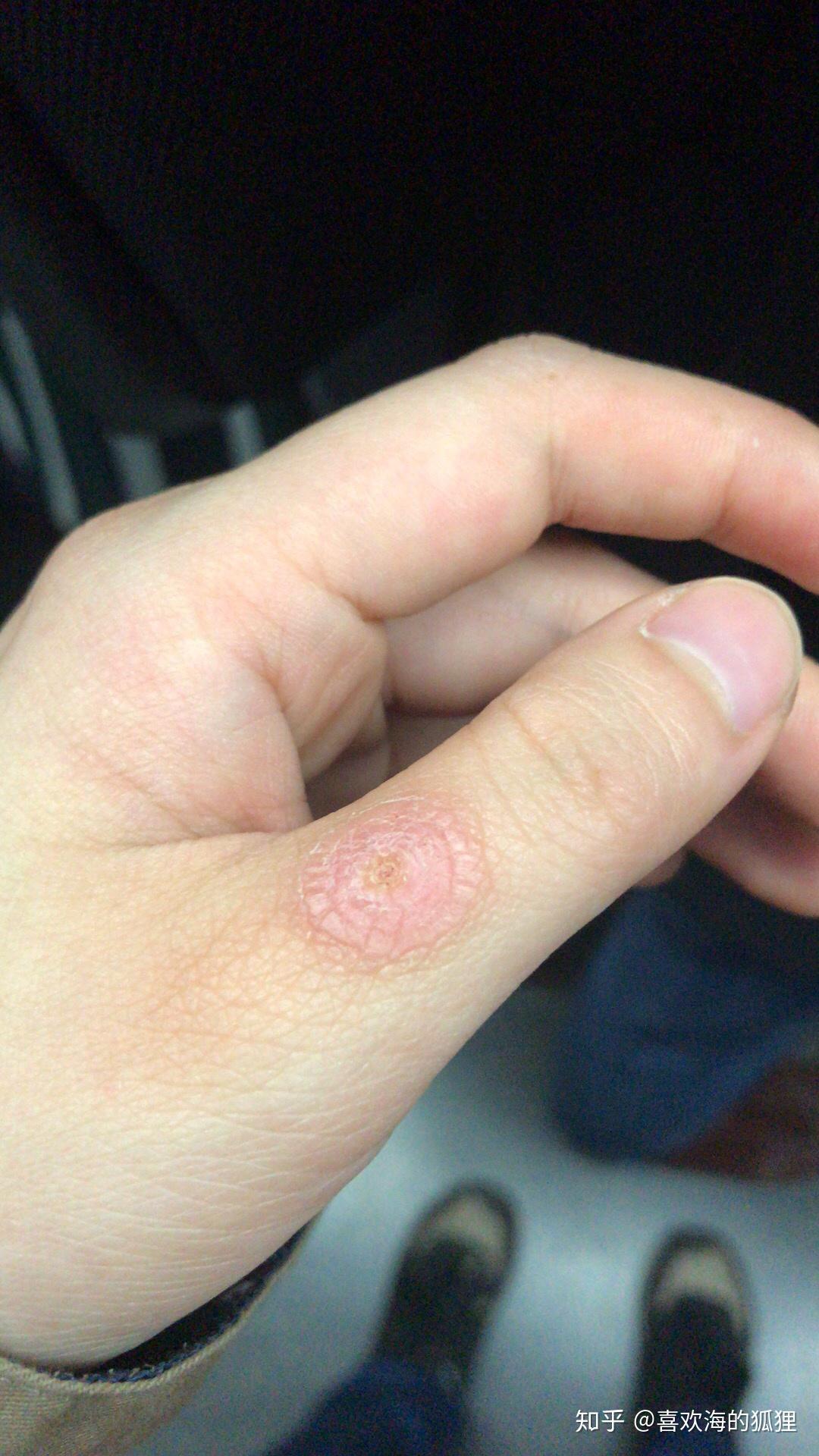 手上长了个小肉球不知道该肿么办求大神帮忙