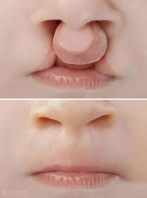 六个月胎儿唇腭裂图片图片