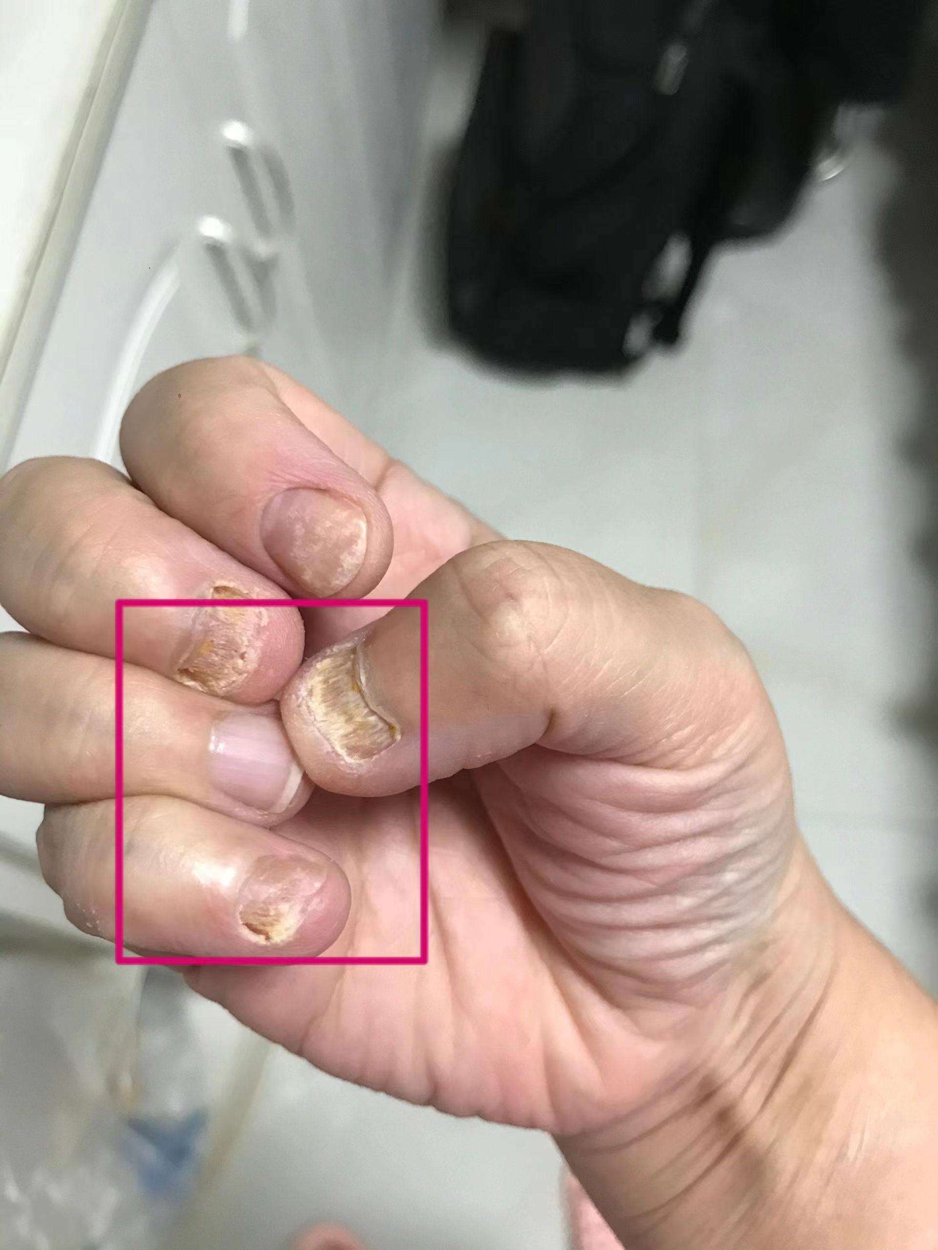 请问各位大神这个是早期灰指甲吗是的话有什么适合我的治疗方法吗