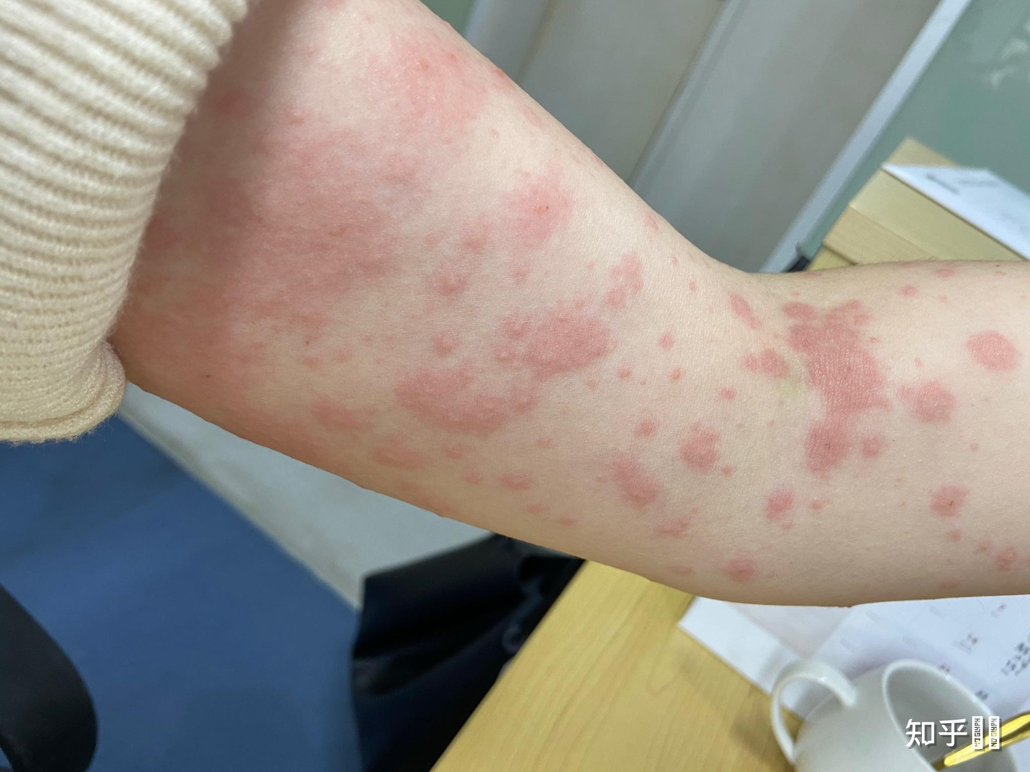 对猫皮屑过敏,脱敏治疗有成功的吗? - 知乎