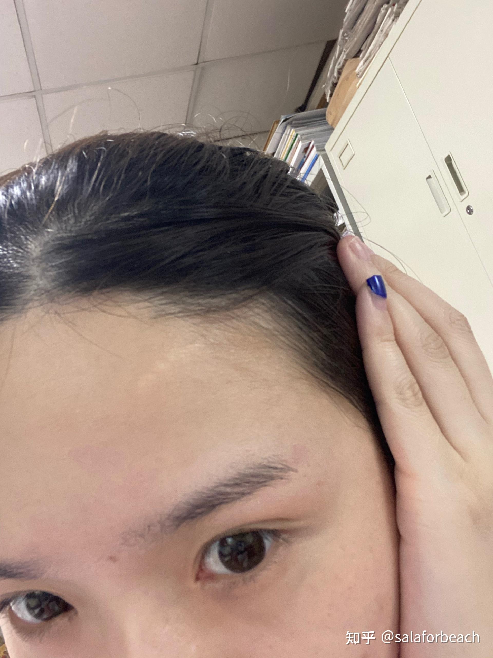 小时候额头摔跤缝针的长大后都怎么样了,? - 知乎