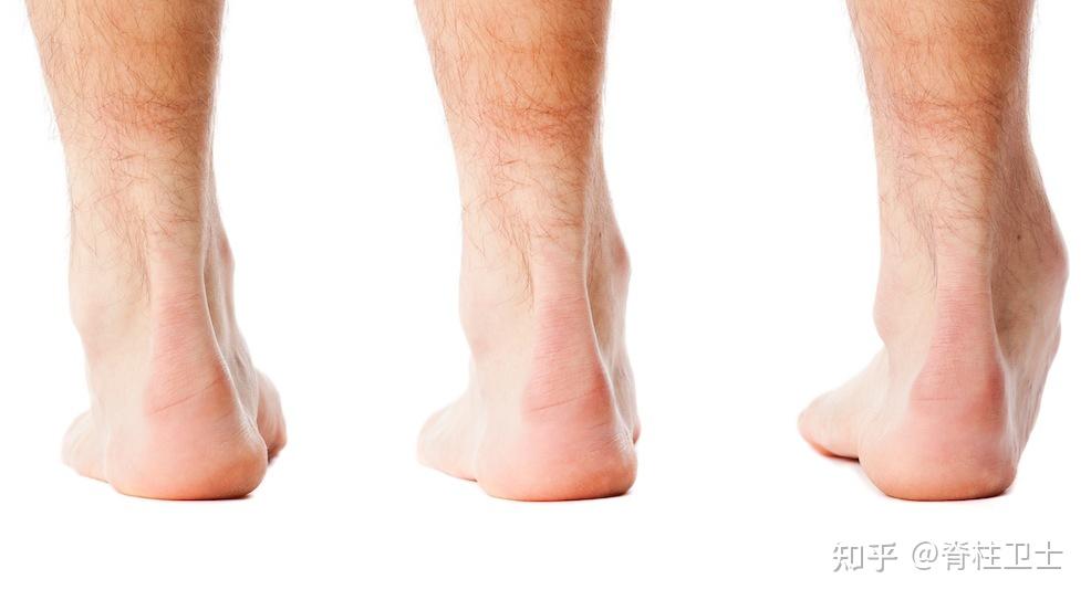 平足是什么样子的