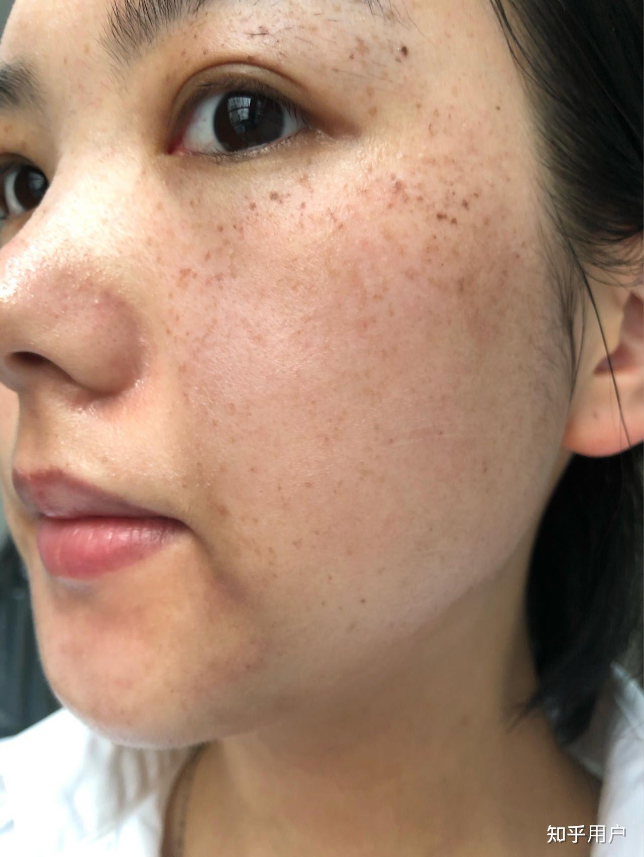 什么祛斑产品好用呢? - 知乎