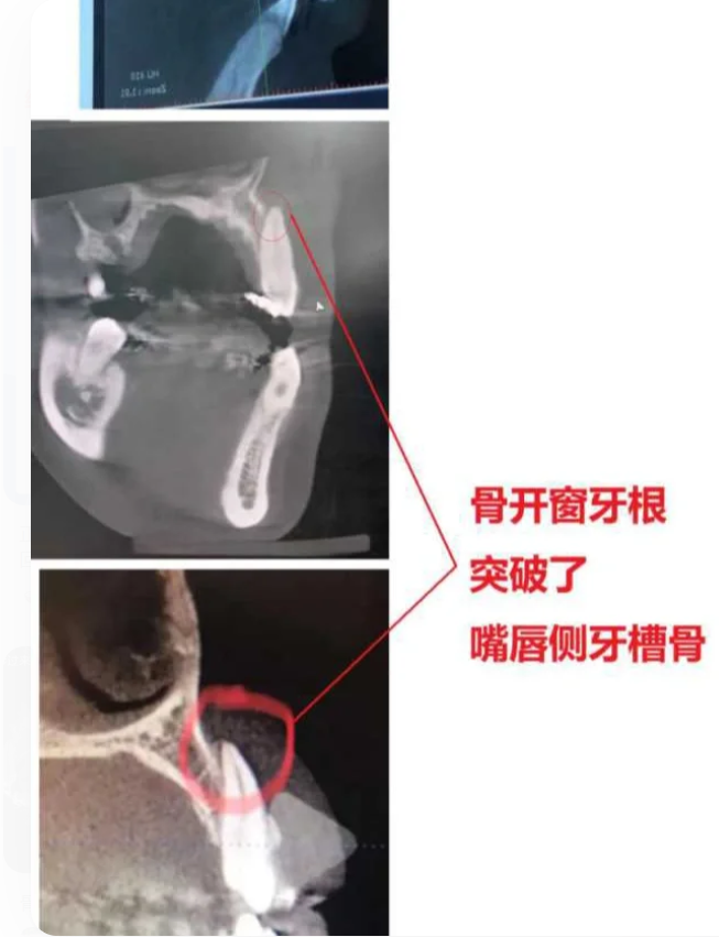 南京牙齿矫正骨开窗?