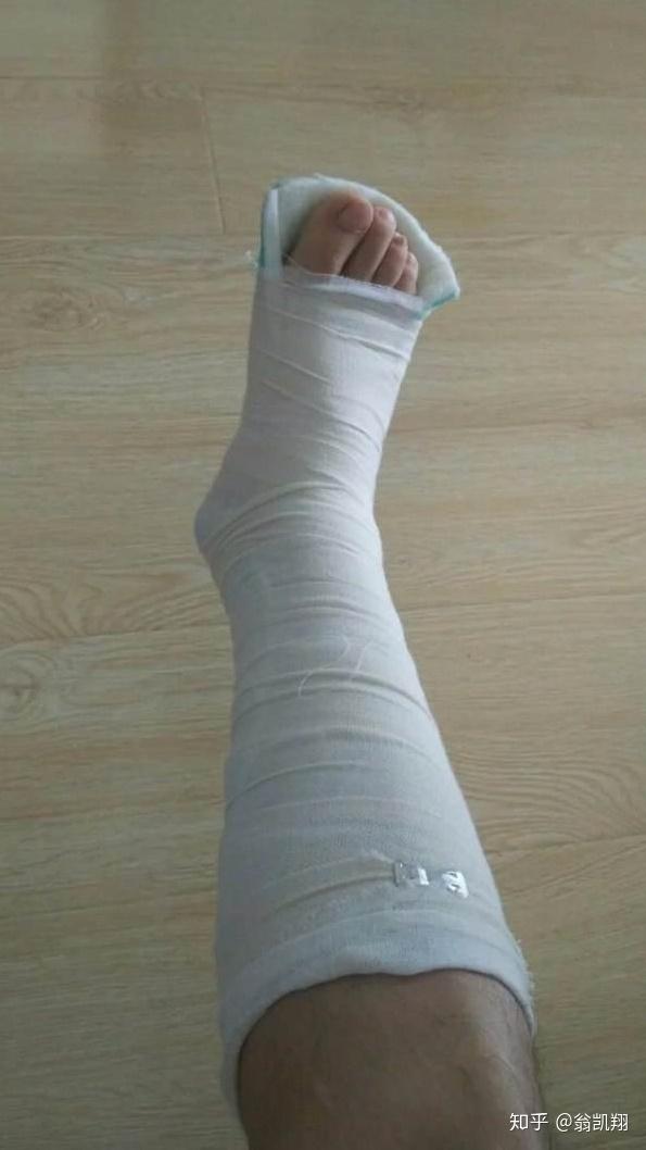 脚踝骨折怎么做才能恢复的快?