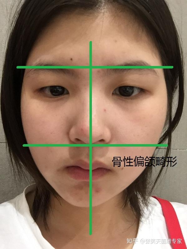 面部骨骼不对称? - 知乎
