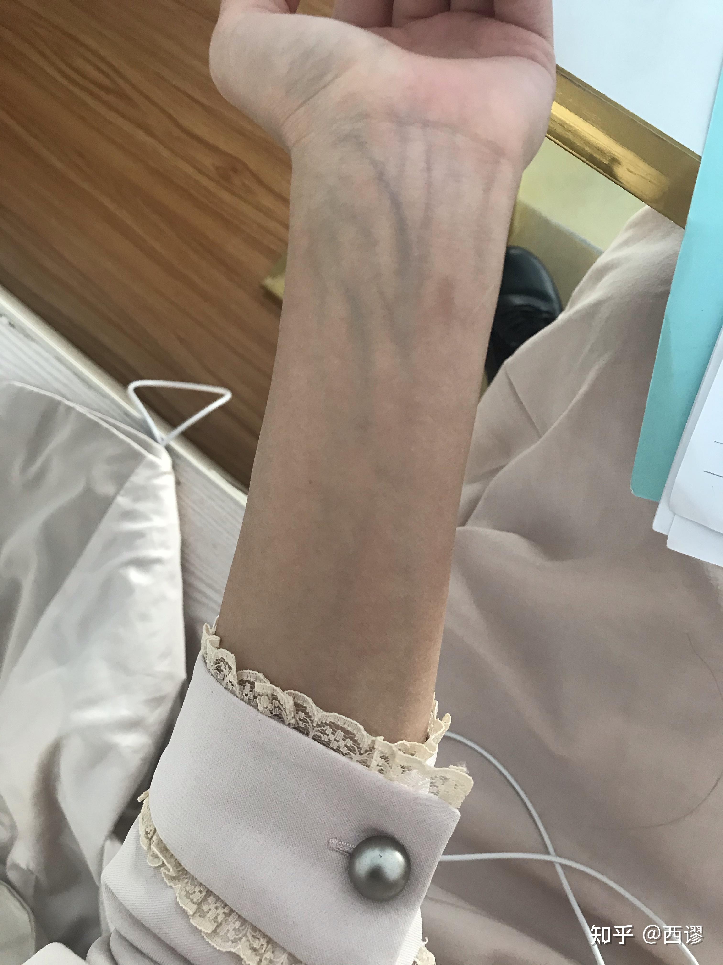 手腕上静脉颜色很明显,是身体有什么病症的原因吗?