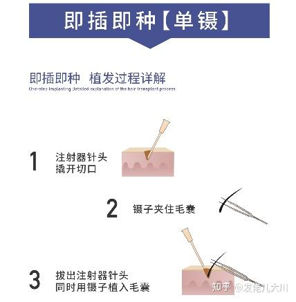 微针植发技术图片