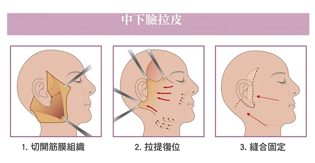 大拉皮和小拉皮的区别都有哪些?