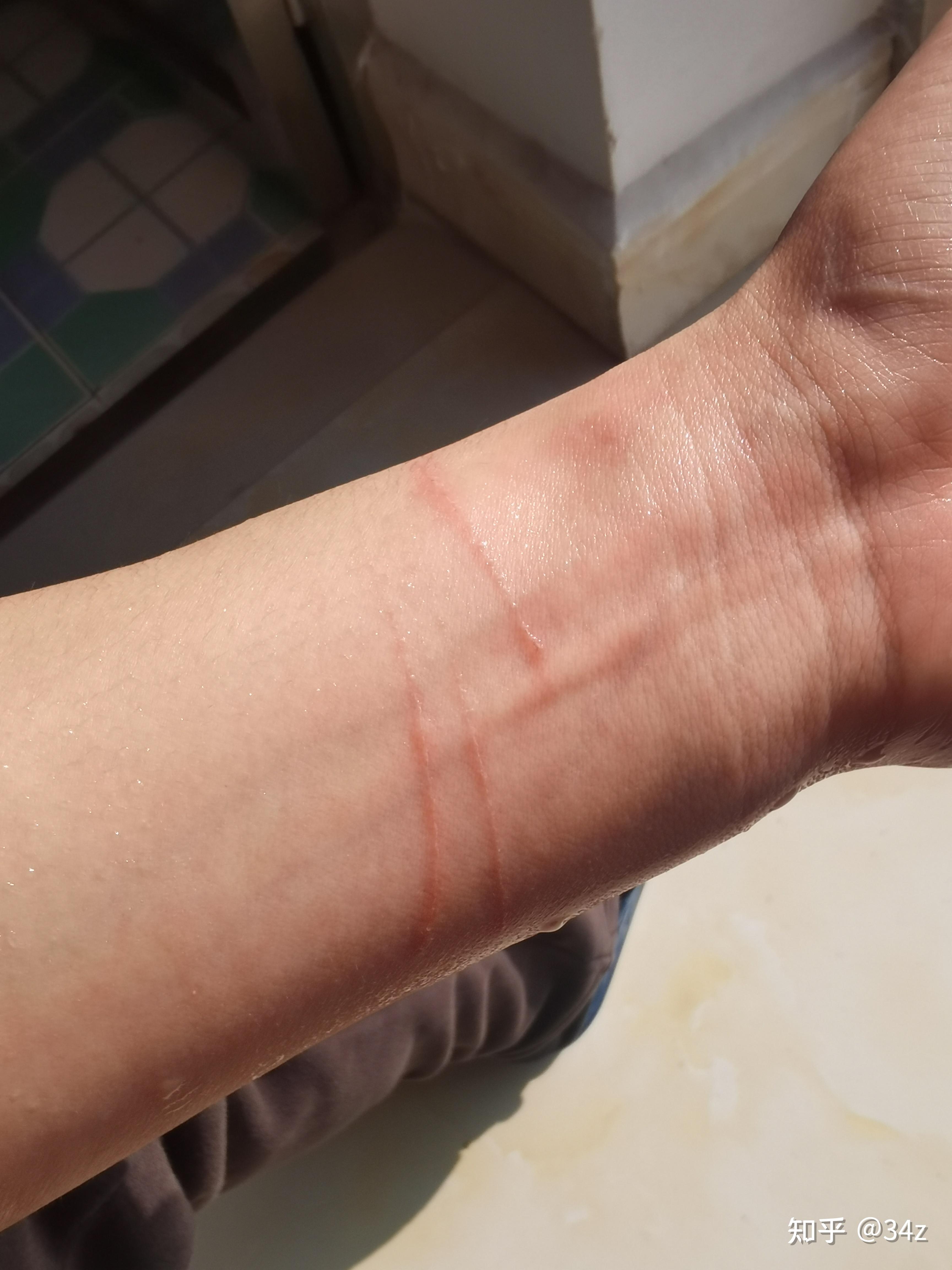 被两个月小奶猫抓伤了?