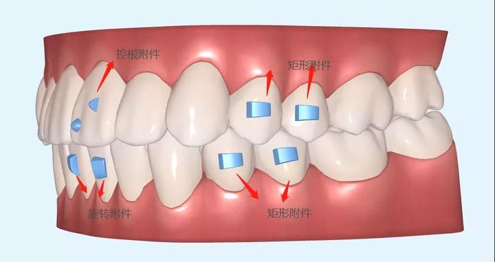 隐形牙套还有附件它有什么作用呢