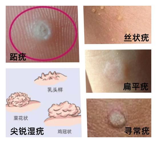 身上长了疣,就是私生活不检点吗? - 知乎