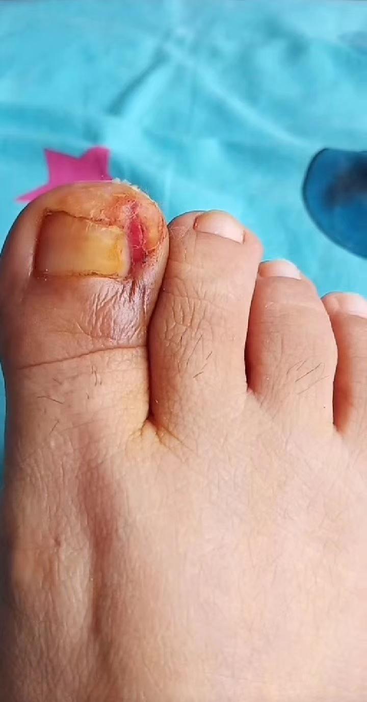 轻重甲沟炎做到这几点强迫症再不用害怕了彻底解脱