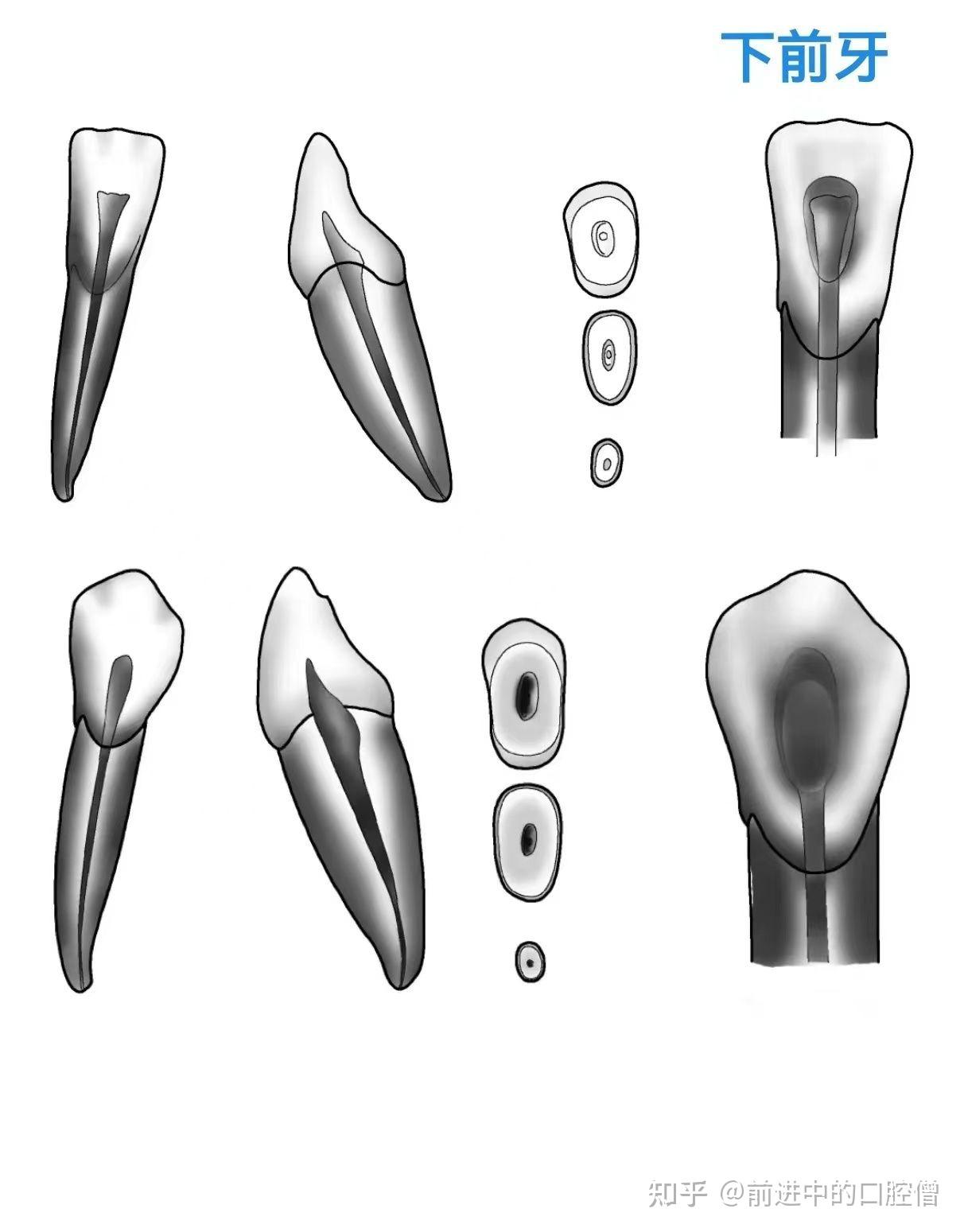 根管治疗图解:6种开髓位置及洞型