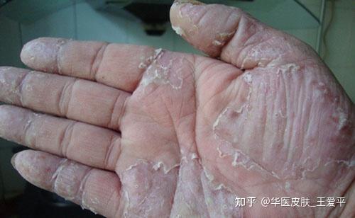 手足癣的常见症状有哪些? - 知乎