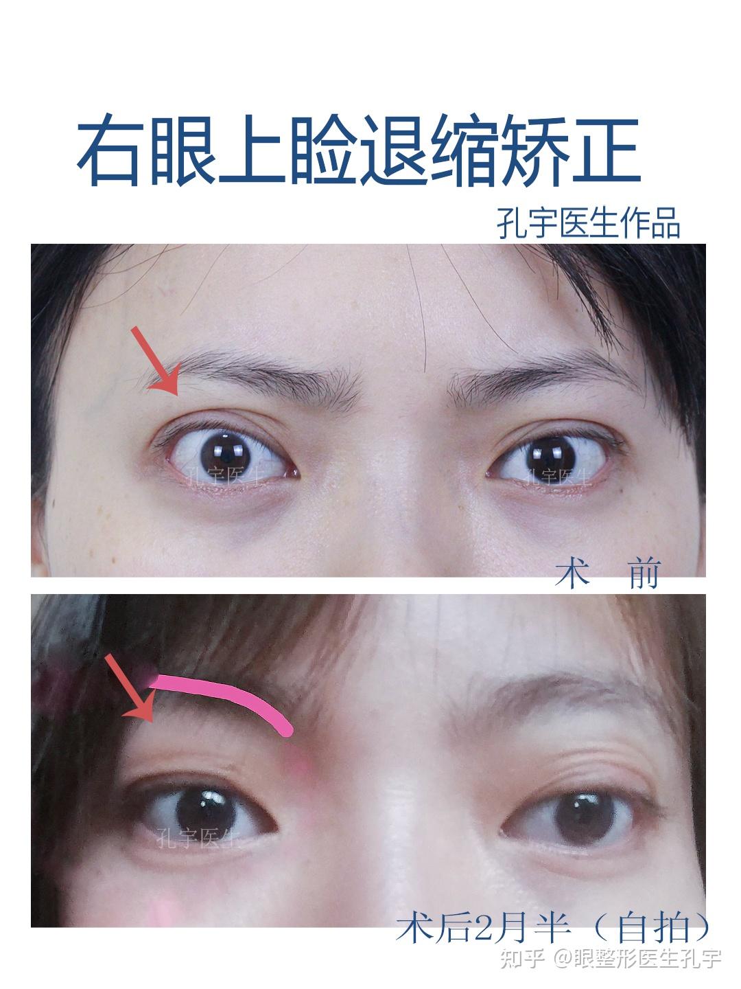 你知道眼睑退缩吗?眼睑退缩如何矫正? - 知乎