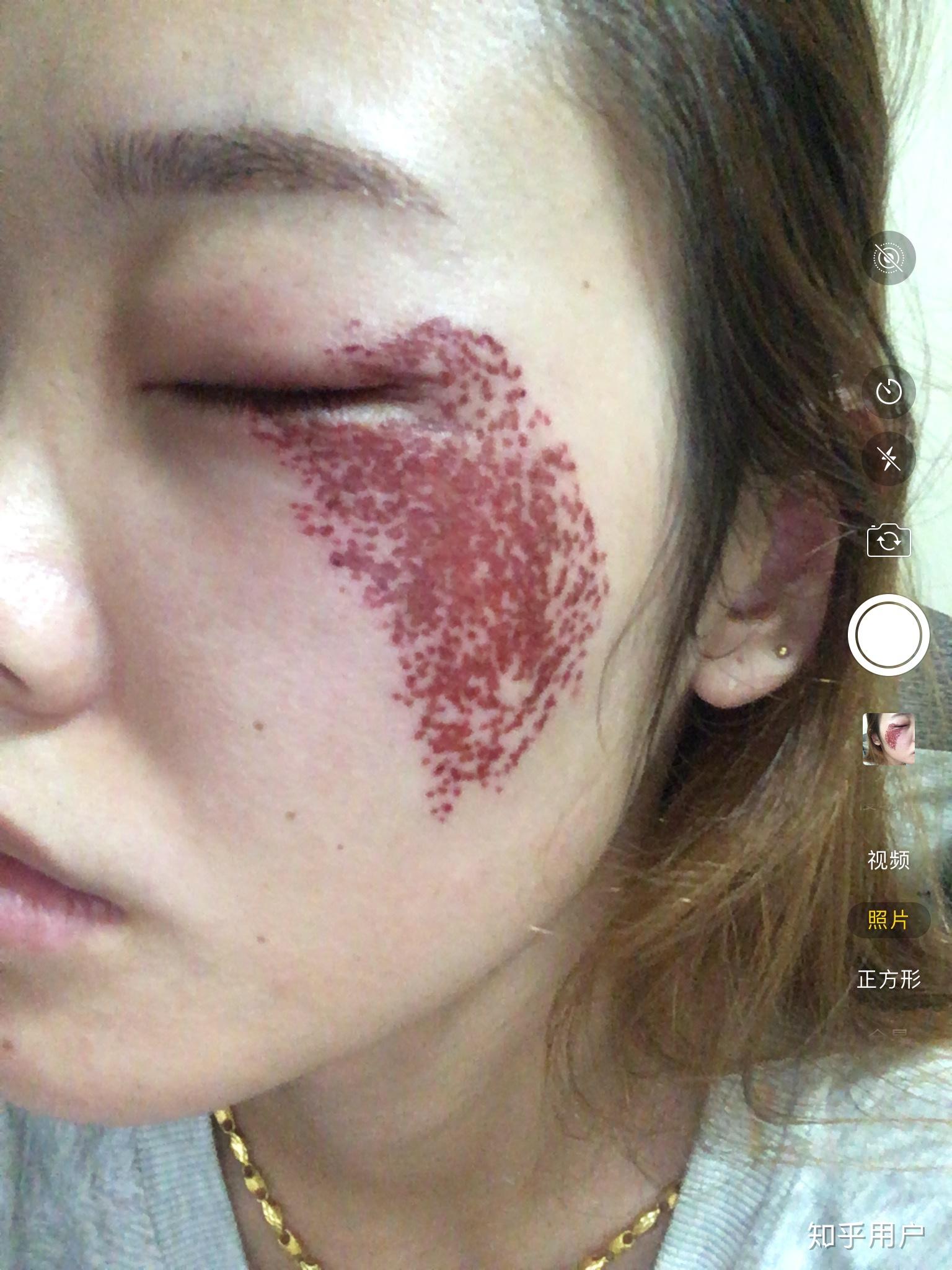 为什么我的调q激光做完都是血印子