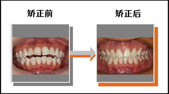 牙齿开合,嘴唇闭不上,戴牙套能矫正吗? - 知乎