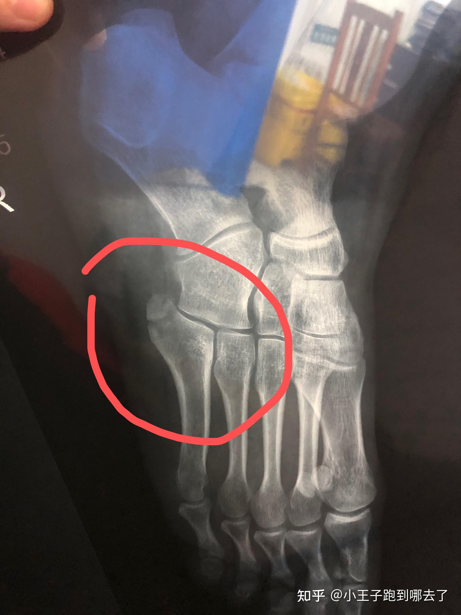 第五趾跖骨骨折多久可以走路? - 知乎