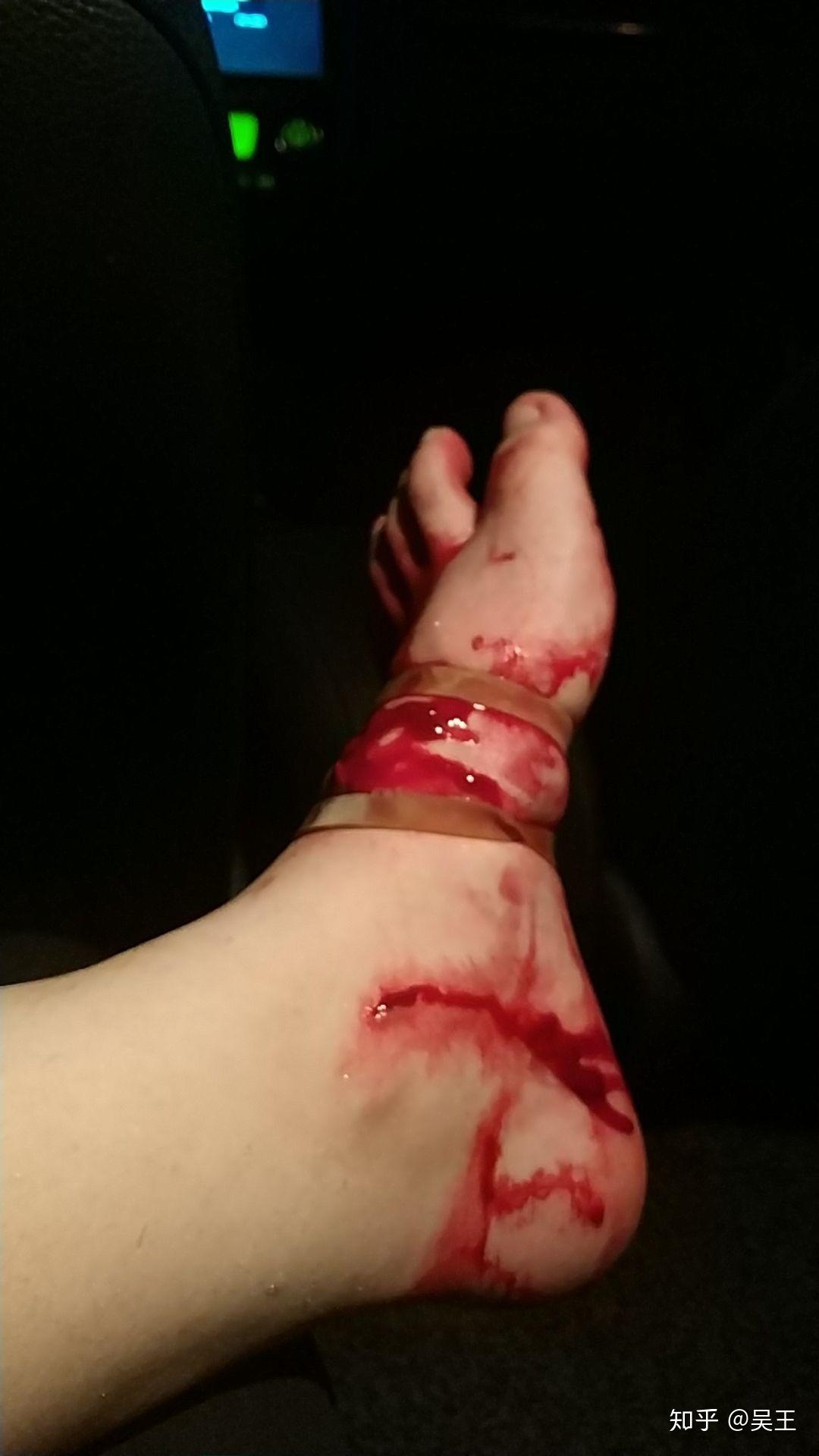 如果手腕动脉被砍断救护车还有10分钟要不要用卫生纸包扎