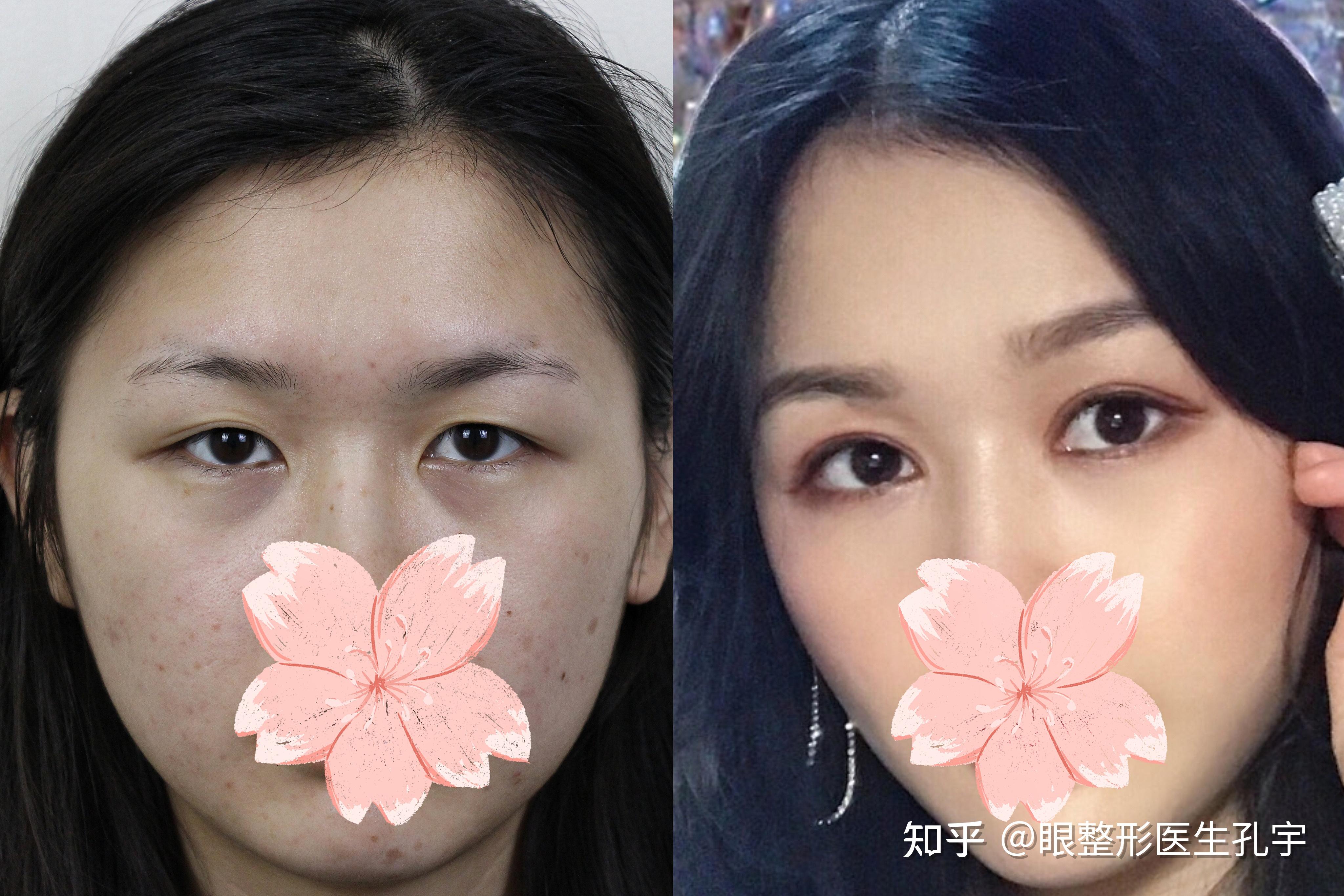 内双肿眼泡割哪种? - 知乎