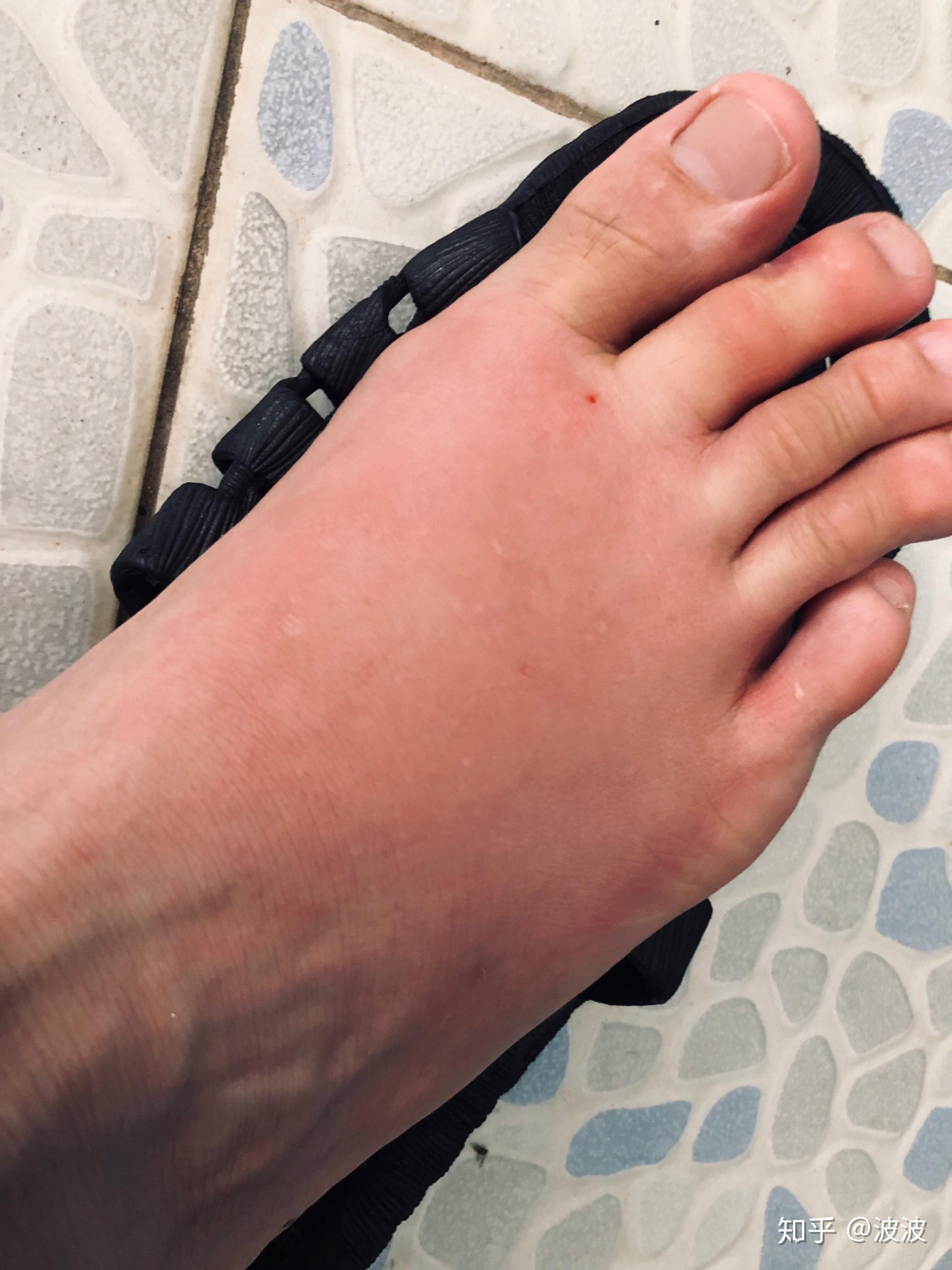 被蚂蚁咬了抠破一次然后现在又红眼痒又肿该怎么处理