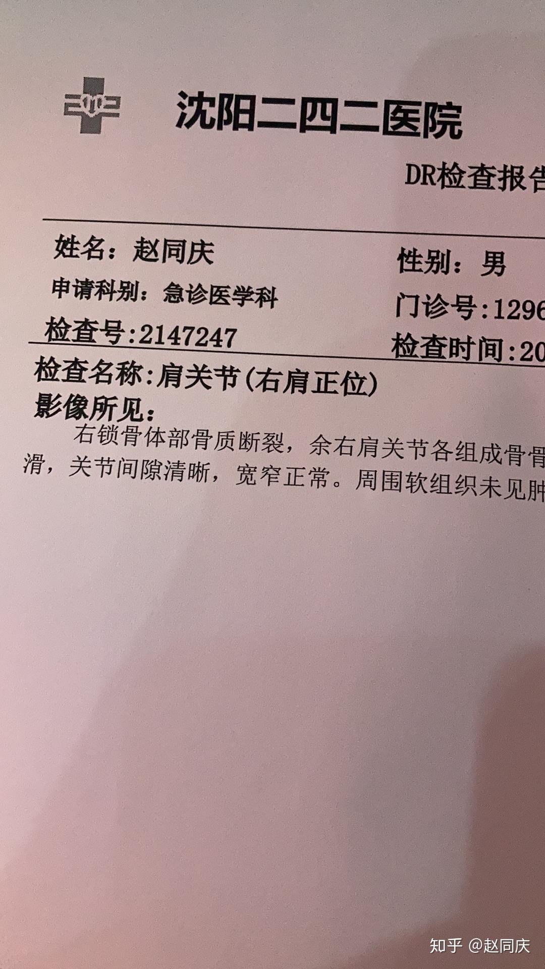 右侧锁骨骨折,有的医生说建议手术,有的说不需要.发上来大家看看!