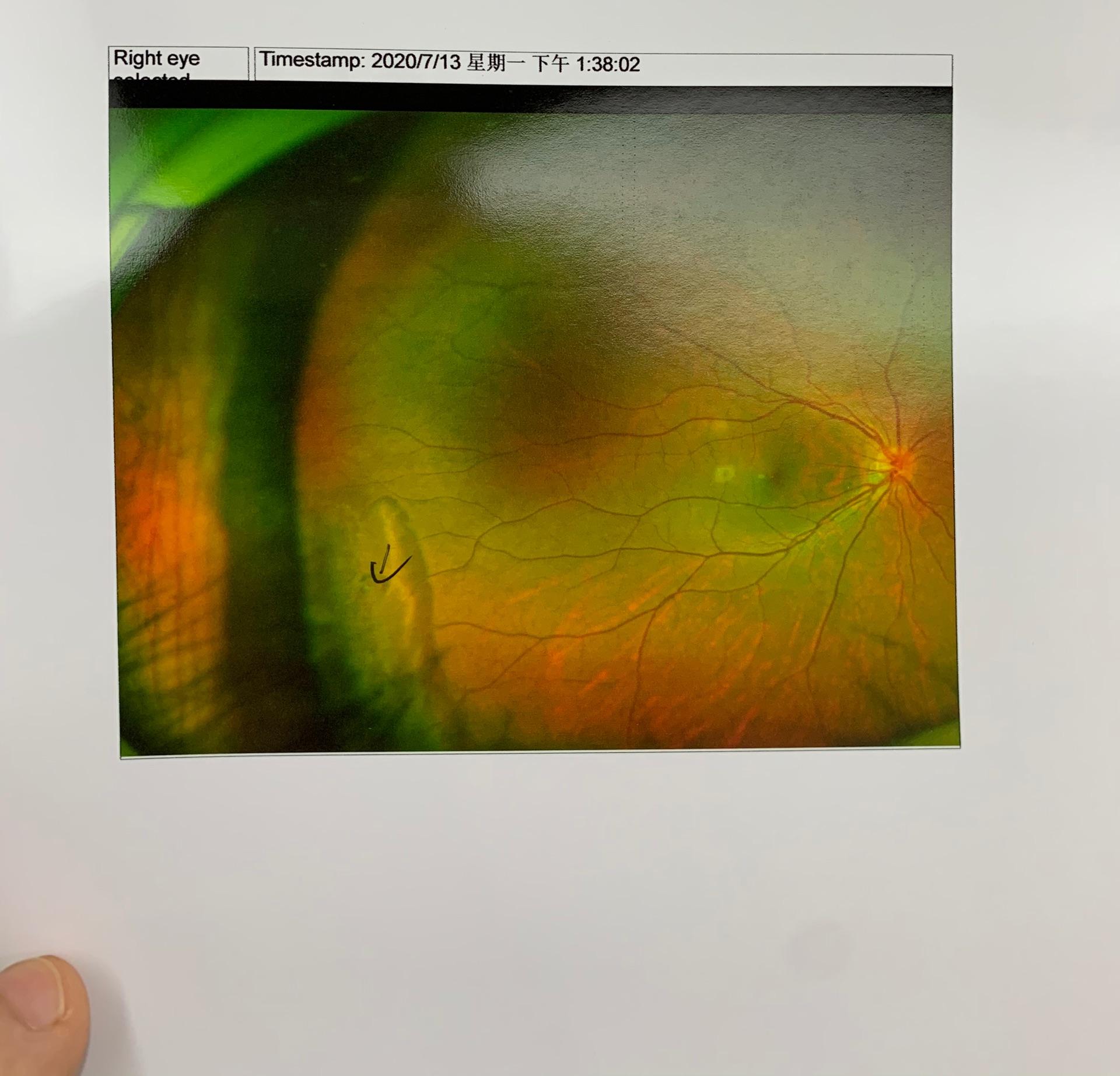 视网膜变性不知道是否一定需要打激光求解求分析