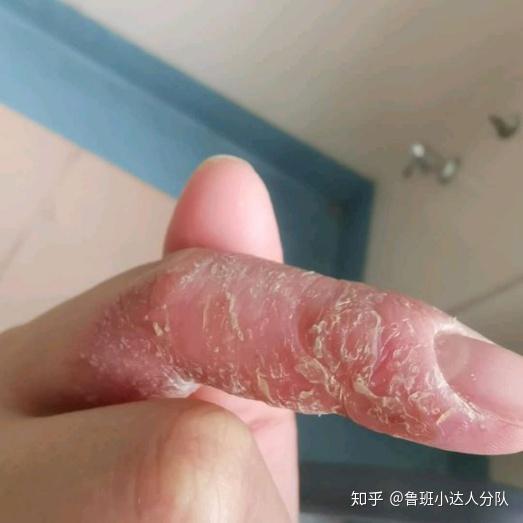 如何区分手指皮肤开裂是真菌还是湿疹?